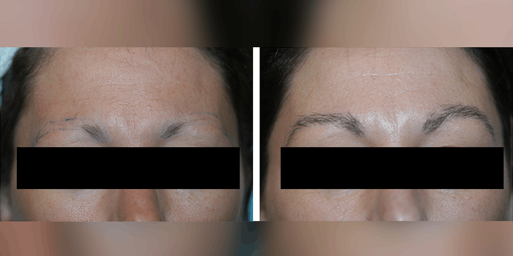 Before and after photos of a female patient after a successful eyebrow transplant performed by Dr. Paul J. McAndrews.