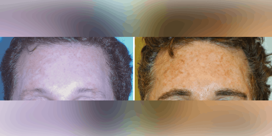 Before and after photos of a male patient after a successful eyebrow transplant performed by Dr. Paul J. McAndrews.