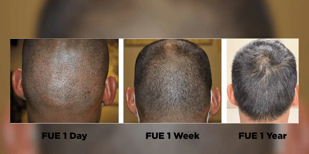 Before and after results for a FUE hair transplant by Dr. Paul McAndrews.