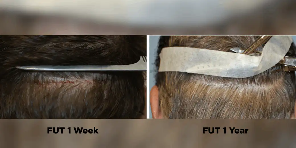 1 week vs 1 year results for a FUT hair transplant by Dr. Paul McAndrews.