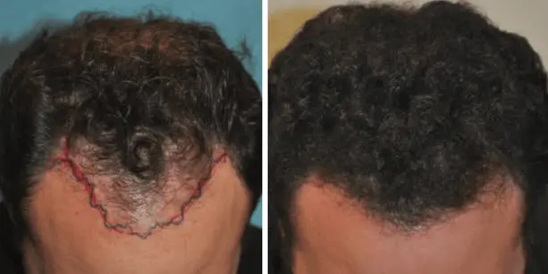 Before and after photos of a 24 year old male patient after a hair transplant performed by Dr. Paul J. McAndrews.